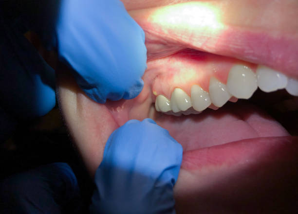 Best Emergency Dentist for Lost Fillings or Crowns in Claude, TX